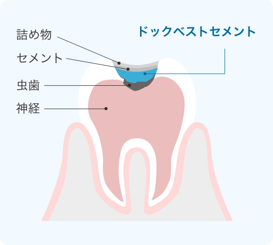 虫歯治療の詰め物